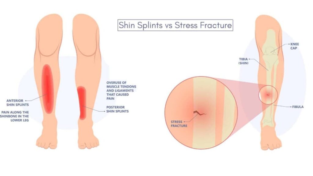 Shin splints vs stress fracture discussion